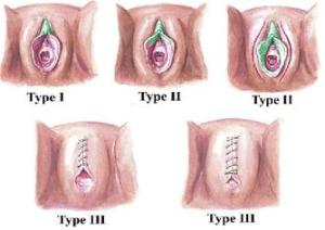 3 types of FGM